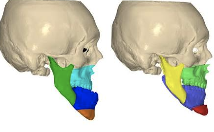 Orthognathic Jaw Surgery 1
