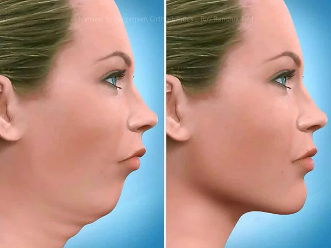 Orthognathic Jaw Surgery 2