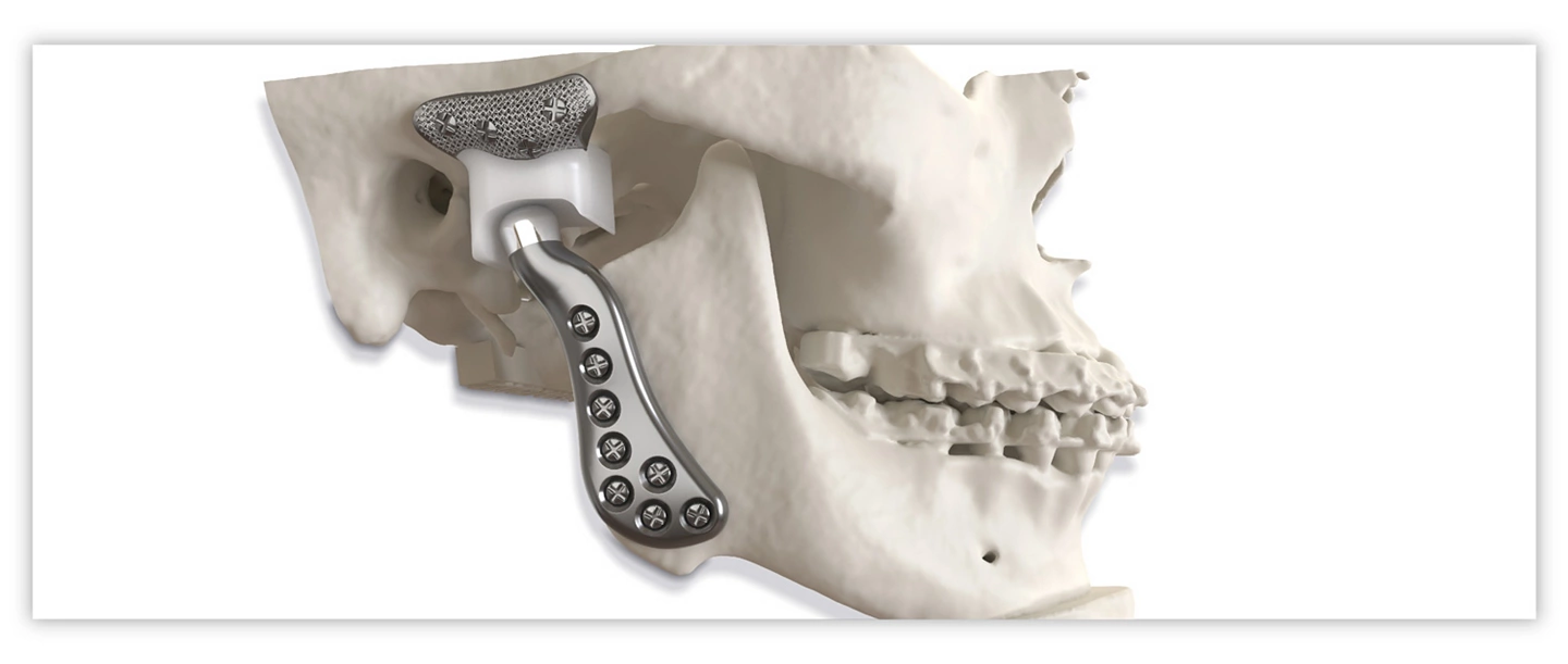 TMJ Surgery 1