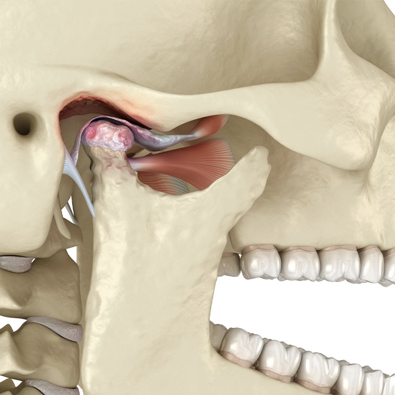 TMJ Surgery 3