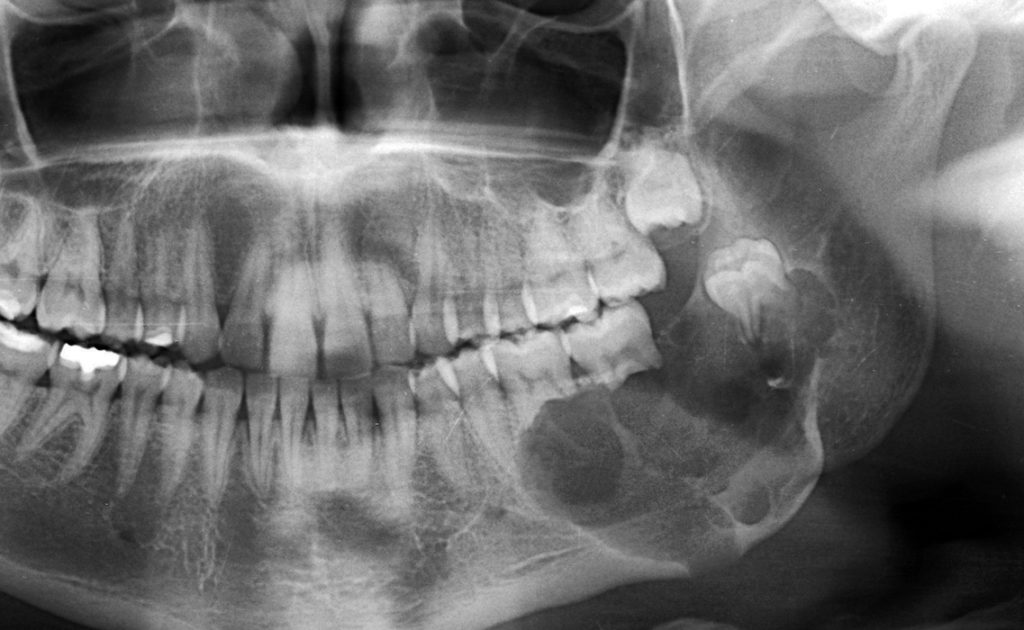 Jaw Cysts and Tumours 1