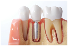 Dental Implants