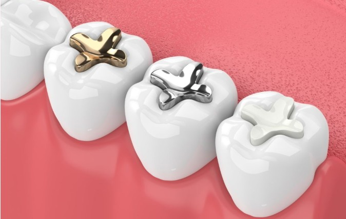 Fillings & Restorative