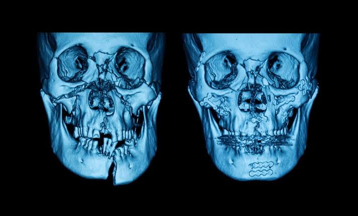 Facial Fracture 1