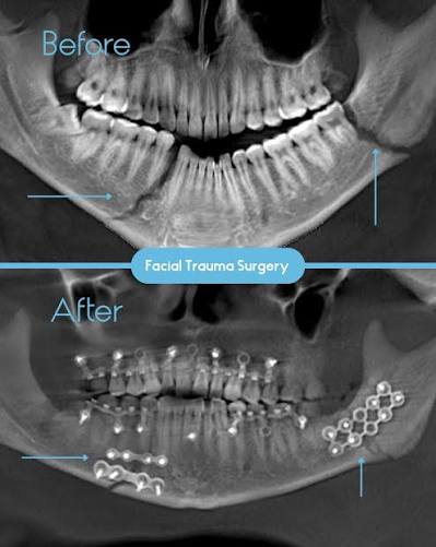 Facial Fracture 2